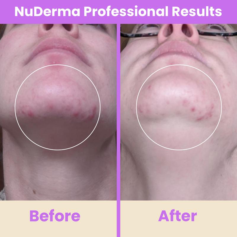 NuDerma Professional High Frequency Wand by Pure Daily Care with Argon & Neon Applicators Anti-Aging and Anti-Acne