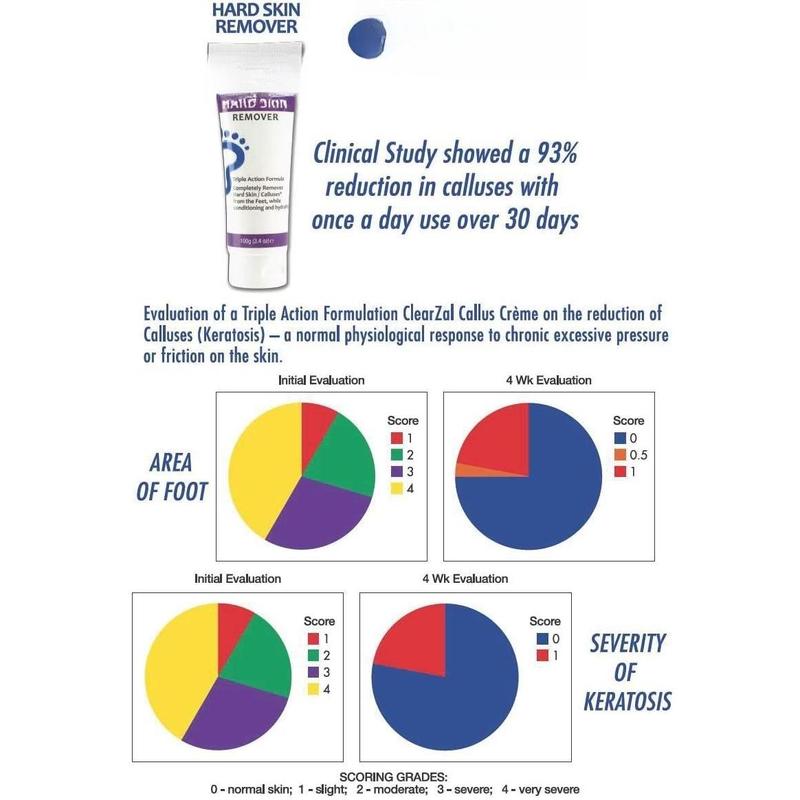 Foot Cream For Hard , Helps Calluses and Corn Removal While Leaving Soft Smooth , Hydrating and Conditioning Triple Action Formula With Aloe Vera, 3.4 Ounce Tube