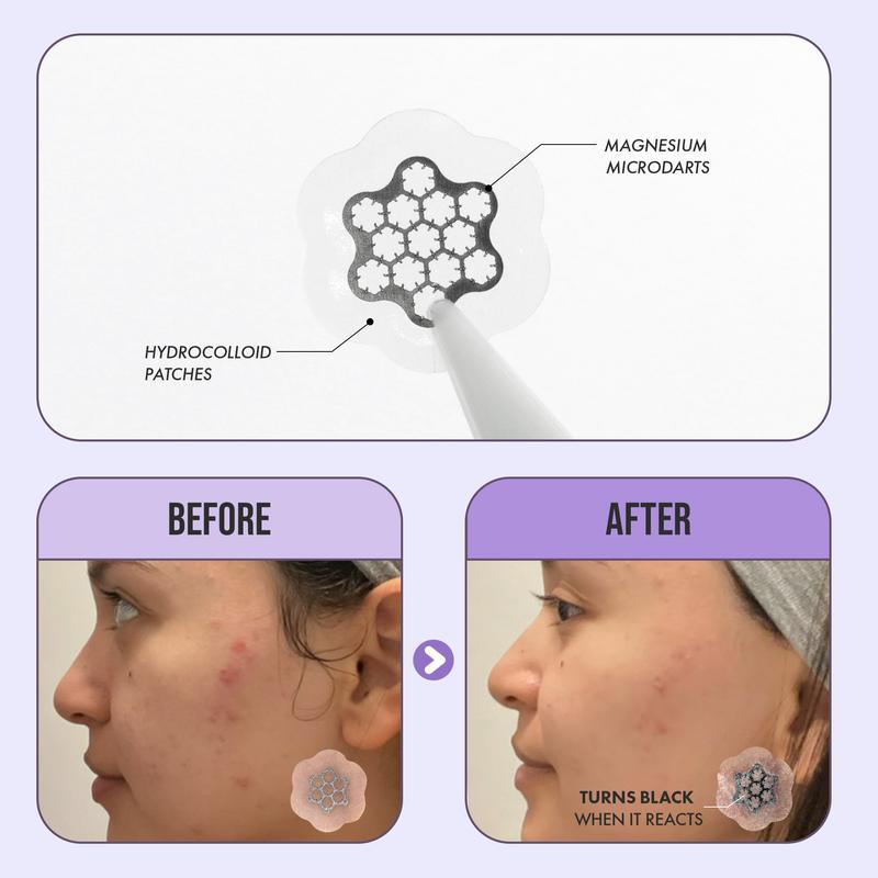 FreeGo Magnesium Acne Patch: Innovative Treatment for Acne, Dark Spots, and Cystic Acne - Patented & Clinically Tested Spot Hydrocolloid Patch