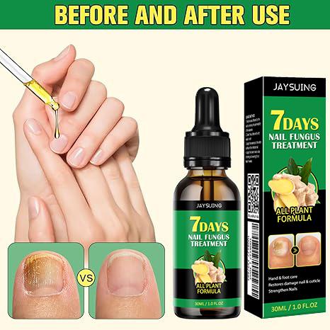 [Buy One Get Two Free Only $14.99] JAYSUING Ginger Nail Treatment Nail Support Nail Care