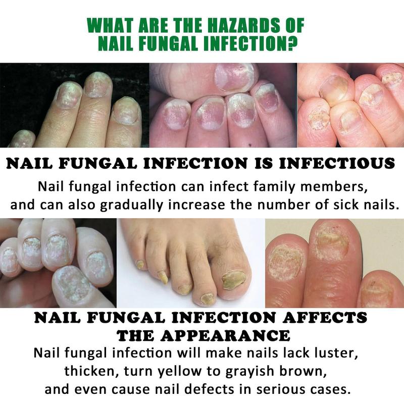 Ginger Nail Treatment for Daily Nail Care and Support - Antibacterial Formula - Manicure Essential